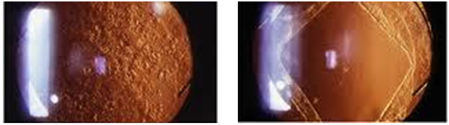 Before and after YAG laser capsulotomy