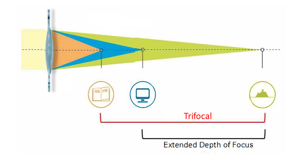 Intraocular lens choices for cataract surgery