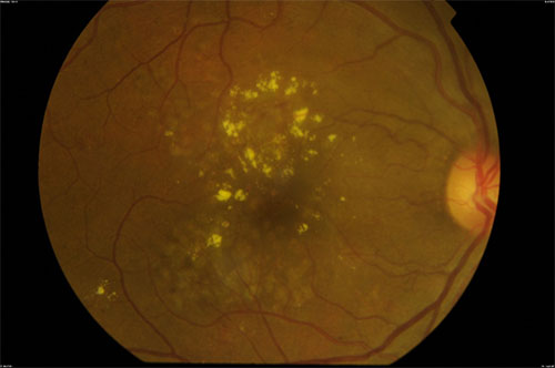 Diabetic macula oedema (DMO) 