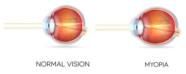 Toric intraocular lenses are designed to reduce the amount of astigmatism in the visual system