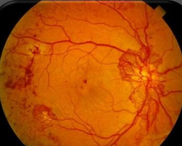 Proliferative diabetic retinopathy 