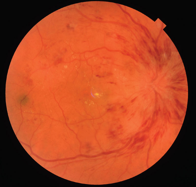 Central serous retinopathy